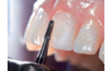 Бори стоматологічні твердосплавні - Удаление адгезива після брекетов