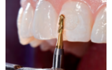 Бори стоматологічні твердосплавні - Удаление пломб і адгезива
