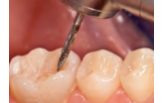 Боры стоматологические твердосплавные - Одношаговые финиры